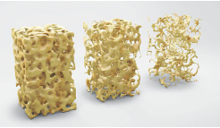 OsteoZinc Plus -PROFILAXIA ȘI TRATAMENTUL COMPLEX AL OSTEOPOROZEI